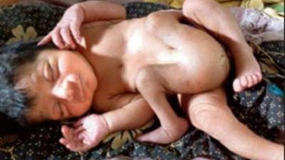 بالفيديو.. مستشفى هندي تشهد حالة ولادة نادرة لطفل بـ 4 أرجل