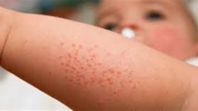 رصد 9 إصابات بحمى «غرب النيل» جنوب إسبانيا