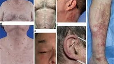 VEXAS.. قصر العيني يوضح أعراض الإصابة بالمرض بعد إعلان اكتشاف أول حالة بمصر 