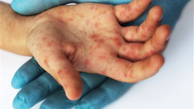 الصحة والتعليم تطمئنان أولياء الأمور: لا داعي لإغلاق المدارس بسبب مرض اليد والفم