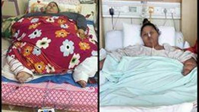 بالفيديو.. طبيبة هندية تنسحب من علاج أسمن امرأة بالعالم بسبب تصريحات شقيقتها